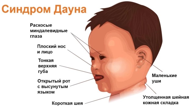 Дети с синдромом Дауна рождаются все чаще: лидирует Бишкек